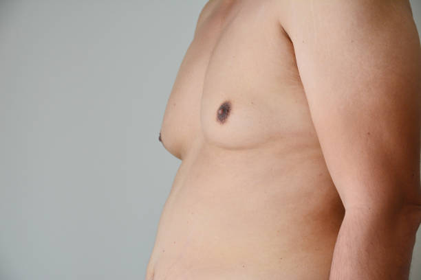 male breast reduction